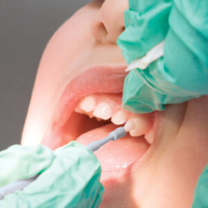 Fluoride varnish