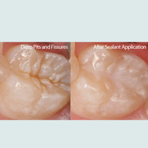 Fissure Sealant