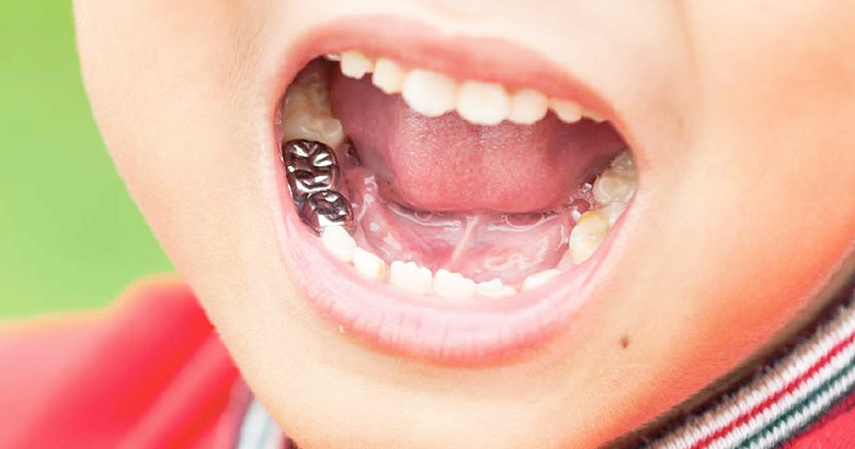 Dental Crowns for baby teeth