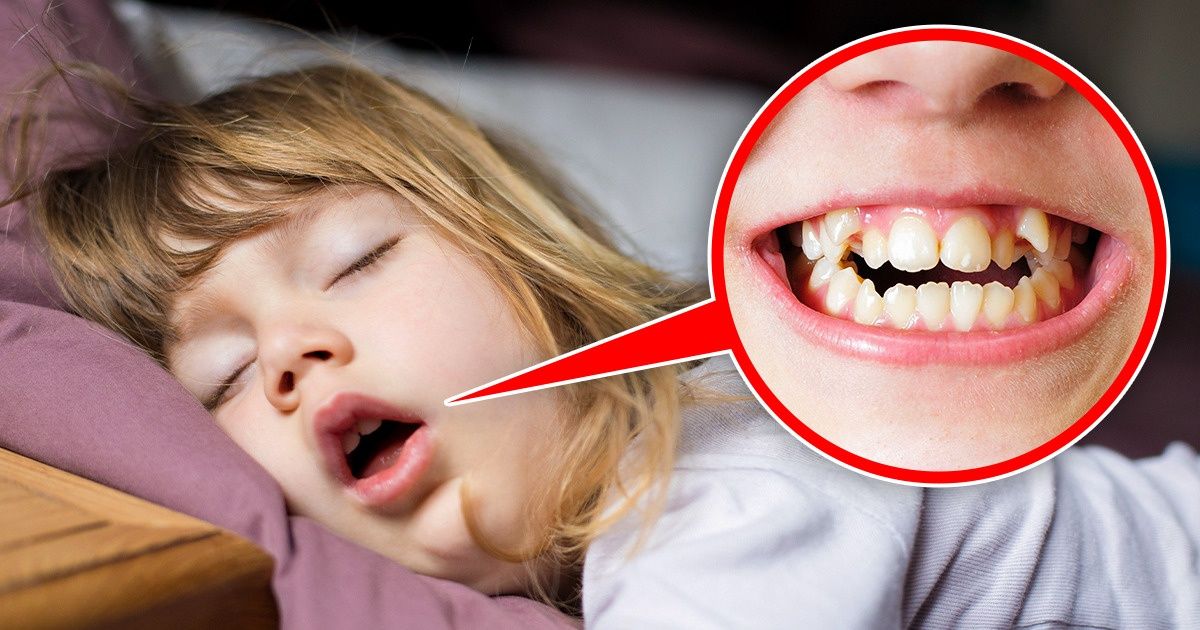 Impact of Mouth Breathing on Kids’ Teeth