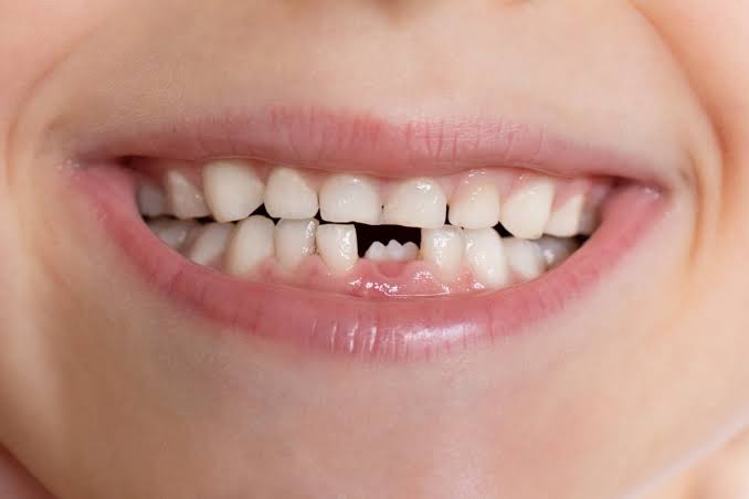 Understanding the Transition From Baby Teeth to Adult Teeth